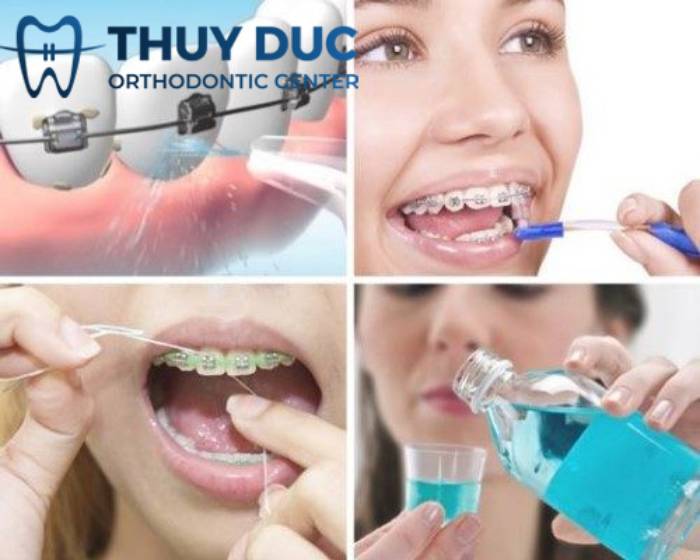 Chăm sóc răng miệng tốt nhất trong và sau quá trình niềng răng 1 Chăm sóc răng miệng tốt nhất trong và sau quá trình niềng răng 1