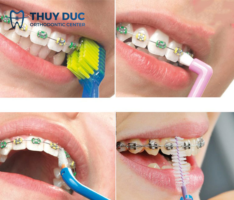 5. Chăm sóc răng miệng đúng cách khi niềng răng, chỉnh nha 1 5. Chăm sóc răng miệng đúng cách khi niềng răng, chỉnh nha 1