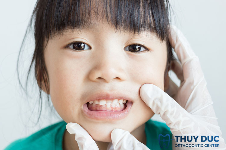 Chỉnh răng móm cho bé cần chú ý điều gì? 1