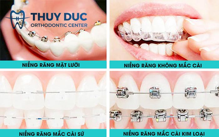 Giải pháp điều chỉnh sai lệch răng hiệu quả nhất 1