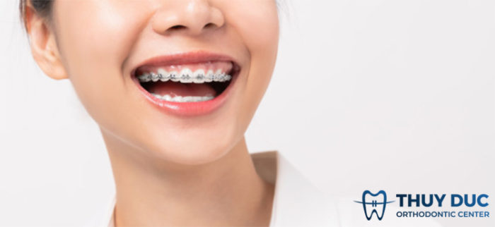 Niềng răng hô hết bao nhiêu tiền? Nên niềng răng hô ở đâu? 1