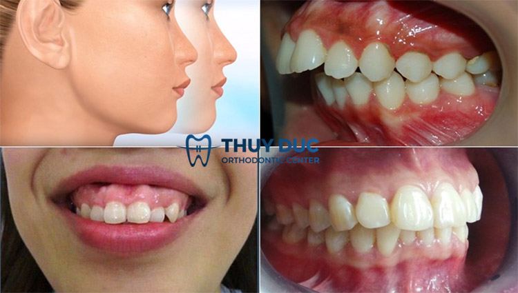 Hàm răng như thế nào là bị hô? 1 Hàm răng như thế nào là bị hô? 1