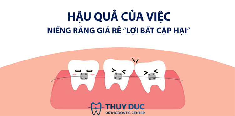 Niềng răng giá rẻ có đi kèm với rủi ro? 1
