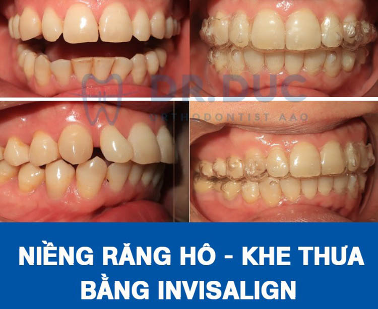 Hình ảnh trước - sau với niềng răng trong suốt Invisalign 1