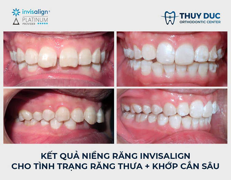 Hình ảnh trước - sau với niềng răng trong suốt Invisalign 2