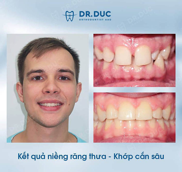 Mách bạn địa chỉ niềng răng tốt nhất 2 Mách bạn địa chỉ niềng răng tốt nhất 2
