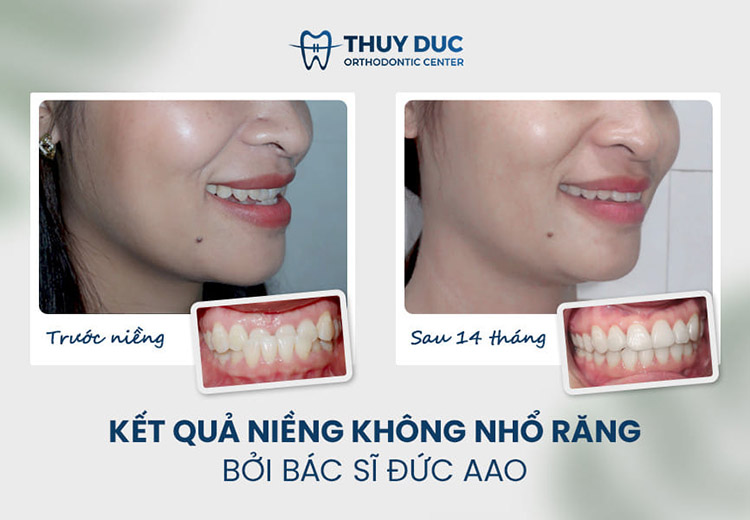 Hình ảnh trước – sau niềng răng với răng sai khớp cắn 1 Hình ảnh trước – sau niềng răng với răng sai khớp cắn 1