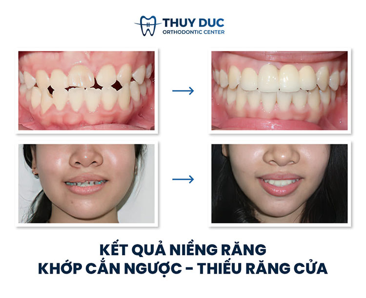 Hình ảnh trước – sau niềng răng với răng sai khớp cắn 2 Hình ảnh trước – sau niềng răng với răng sai khớp cắn 2