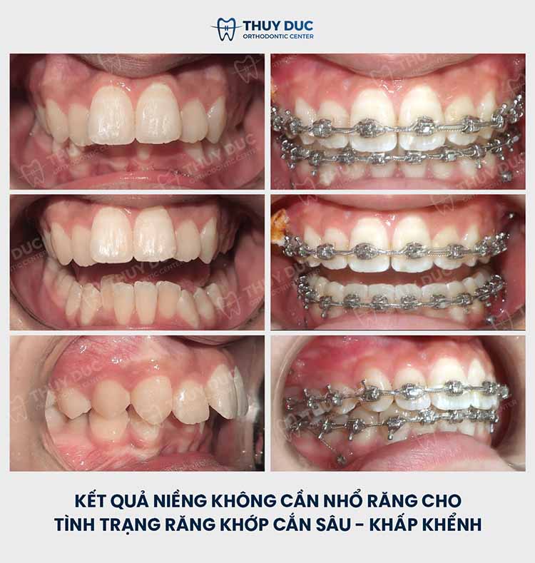 Hình ảnh trước – sau niềng răng với răng sai khớp cắn 3 Hình ảnh trước – sau niềng răng với răng sai khớp cắn 3