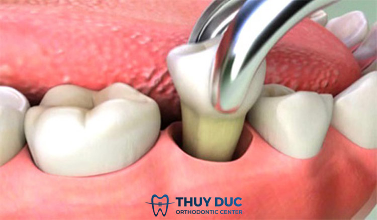 Bạn có thể phải nhổ răng trước khi niềng 1 Bạn có thể phải nhổ răng trước khi niềng 1