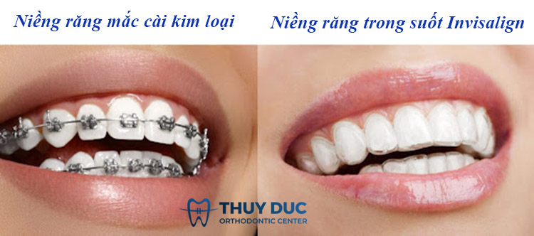 Nhu cầu khi niềng răng 1 Nhu cầu khi niềng răng 1