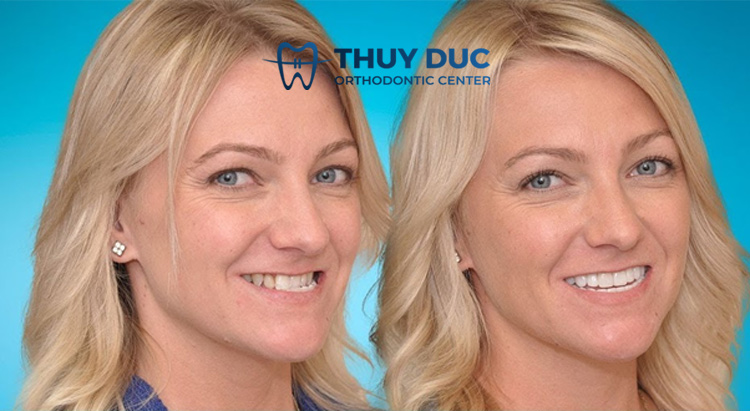 Niềng răng có hết móm không? 1 Niềng răng có hết móm không? 1