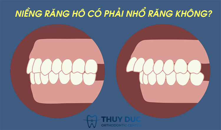 Niềng răng không chỉ giúp sửa các vấn đề về răng sâu mà còn có thể giúp bạn giải quyết tình trạng răng chật và răng nhiều. Hãy đến với chúng tôi để tận hưởng một cái nhìn hoàn hảo về hàm răng của bạn sau khi niềng răng!