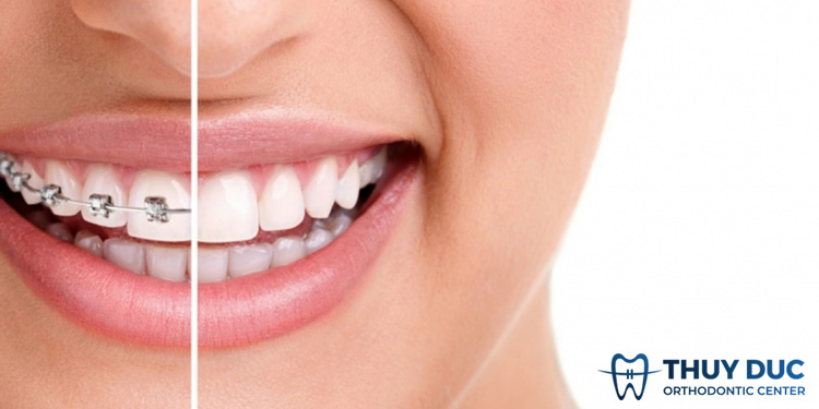 Niềng răng hô mất thời gian bao lâu? 1 Niềng răng hô mất thời gian bao lâu? 1