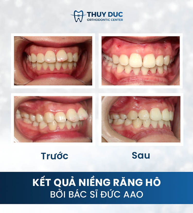 Đa dạng các phương pháp niềng răng hô 3 Đa dạng các phương pháp niềng răng hô 3
