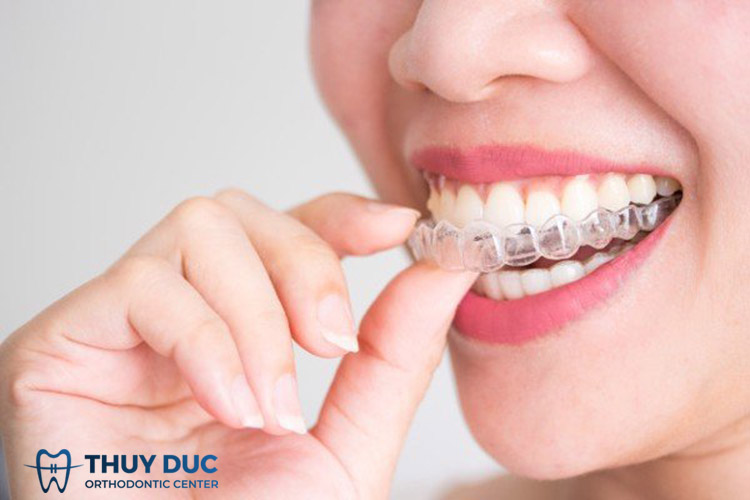 Niềng răng trong suốt Invisalign có điểm gì nổi bật? 1 Niềng răng trong suốt Invisalign có điểm gì nổi bật? 1