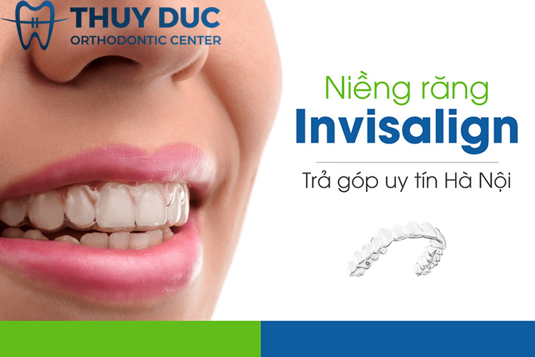 Niềng răng trong suốt trả góp uy tín tại Hà Nội? 1
