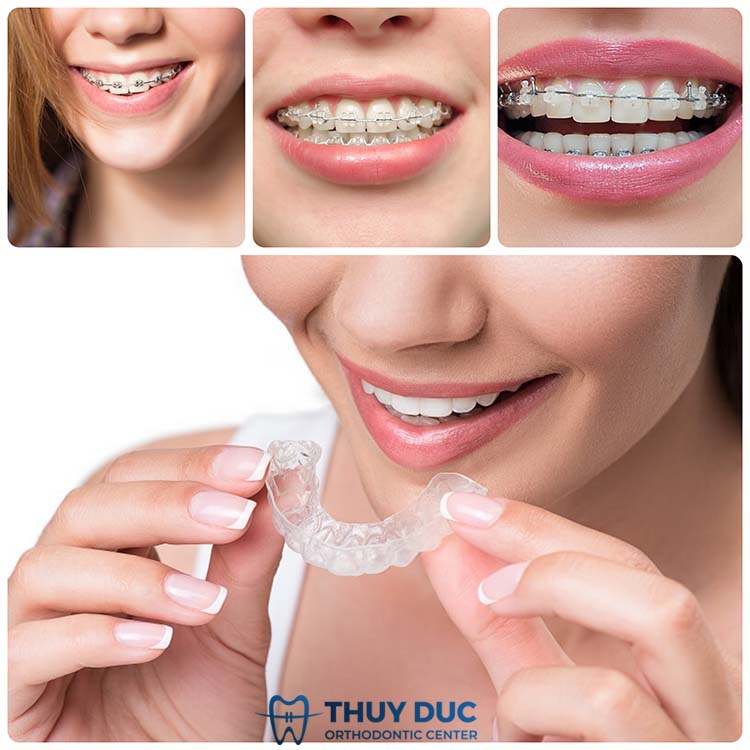 Niềng răng loại nào tốt nhất? 1 Niềng răng loại nào tốt nhất? 1