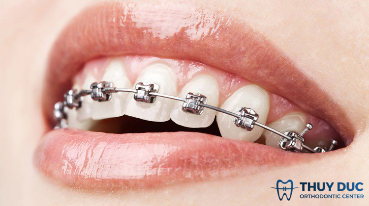 Niềng răng mắc cài kim loại 1