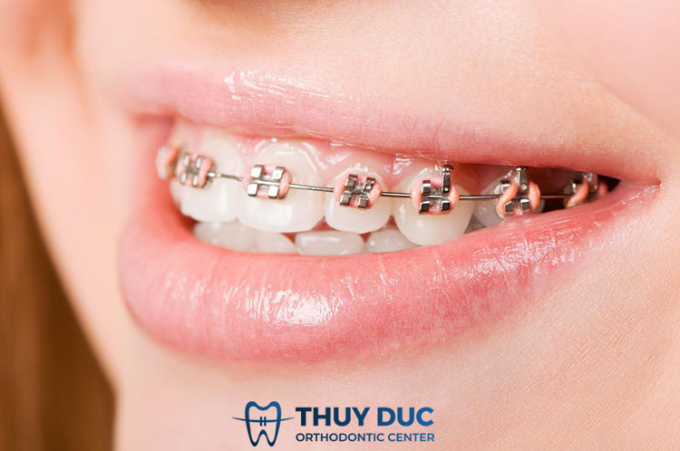 Niềng răng mắc cài kim loại 1 Niềng răng mắc cài kim loại 1