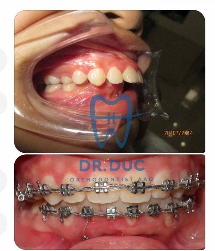 Hình ảnh trước- sau với niềng răng mắc cài kim loại 5 Hình ảnh trước- sau với niềng răng mắc cài kim loại 5