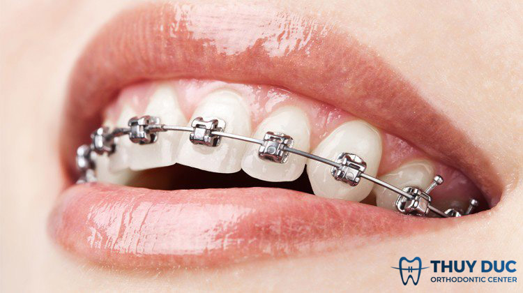 Niềng răng mắc cài tự buộc là gì? 1 Niềng răng mắc cài tự buộc là gì? 1