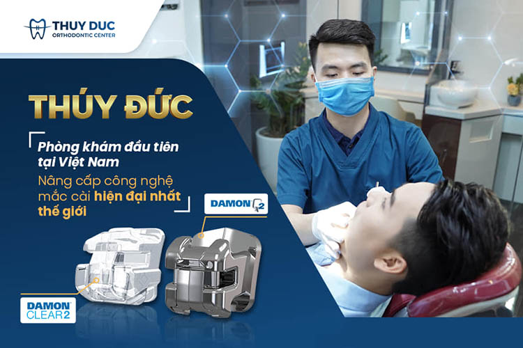 Mắc cài kim loại tự buộc DAMON Q2 1 Mắc cài kim loại tự buộc DAMON Q2 1