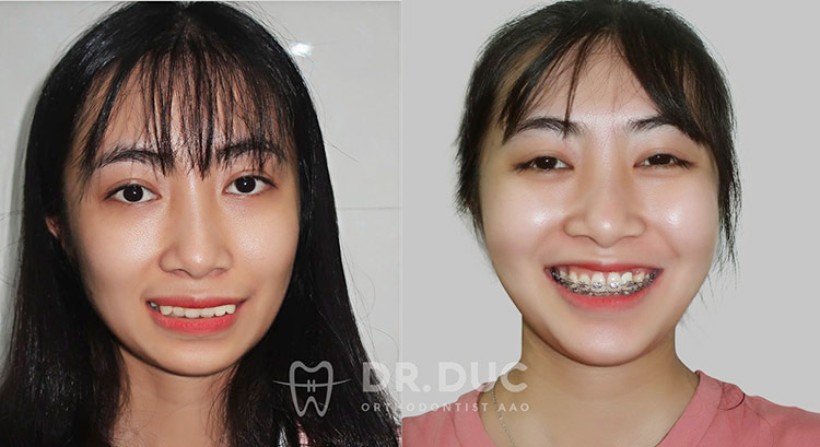 Ưu điểm vượt trội mắc cài kim loại tự buộc DAMON Q2 2 Ưu điểm vượt trội mắc cài kim loại tự buộc DAMON Q2 2