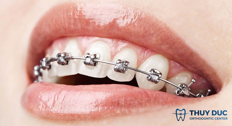 Niềng răng mắc cài kim loại tự động 1 Niềng răng mắc cài kim loại tự động 1