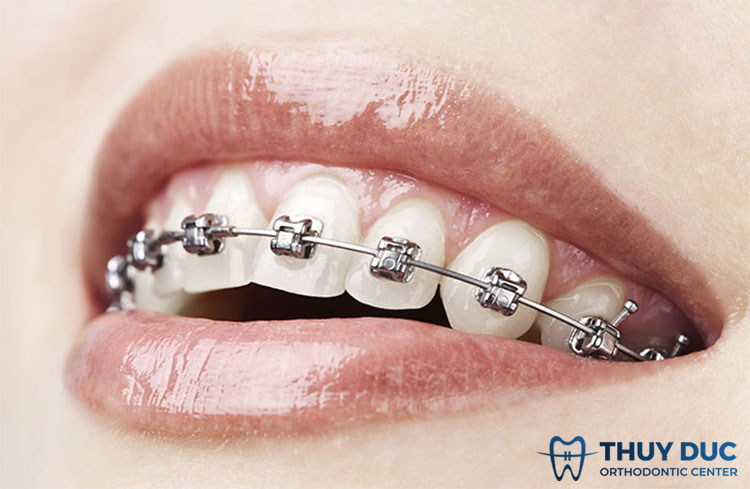 2. Niềng răng mắc cài kim loại tự động 1 2. Niềng răng mắc cài kim loại tự động 1