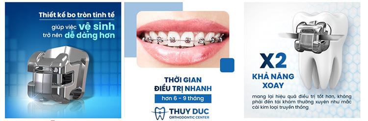 Niềng răng mắc cài kim loại tự động 2 Niềng răng mắc cài kim loại tự động 2