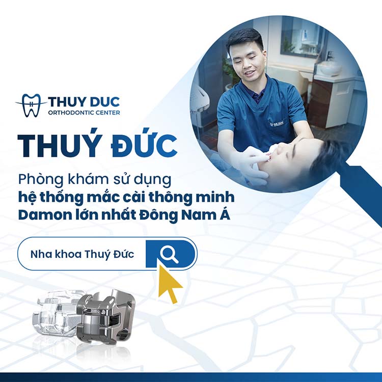 Niềng răng mắc cài 1