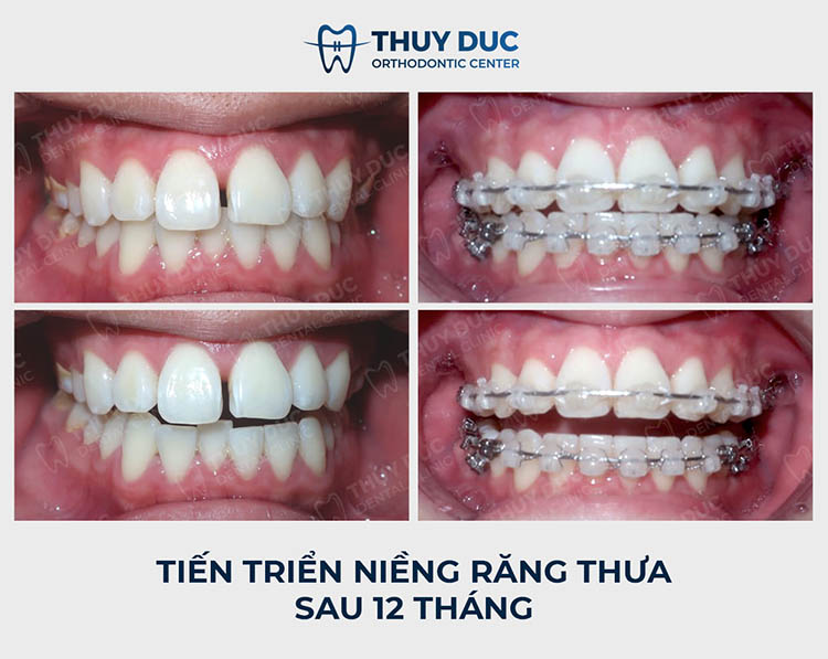 Niềng răng mắc cài 5