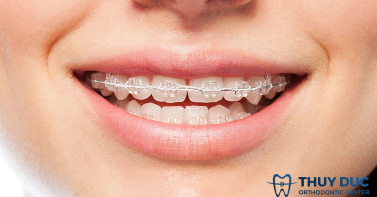 3. Niềng răng mắc cài sứ 1 3. Niềng răng mắc cài sứ 1