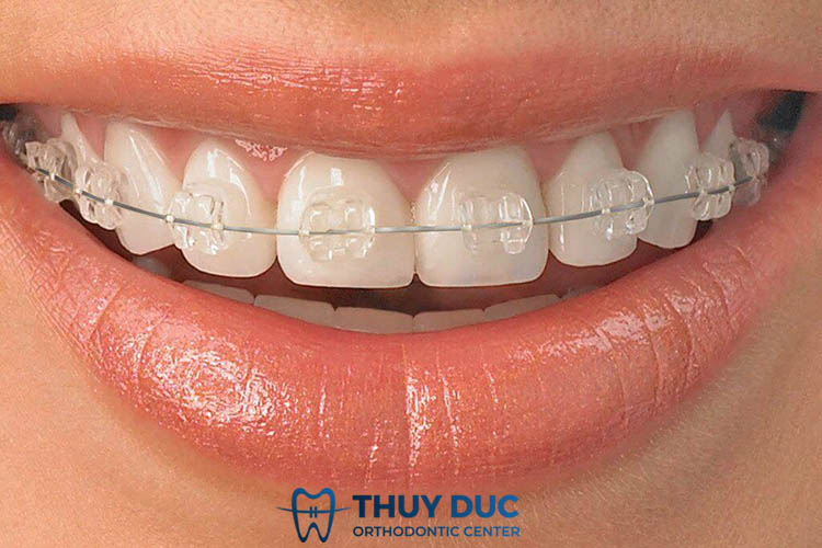 Niềng răng mắc cài sứ thường 1 Niềng răng mắc cài sứ thường 1