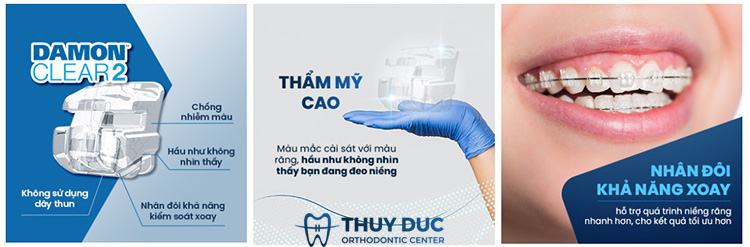 Niềng răng mắc cài sứ tự động 2 Niềng răng mắc cài sứ tự động 2