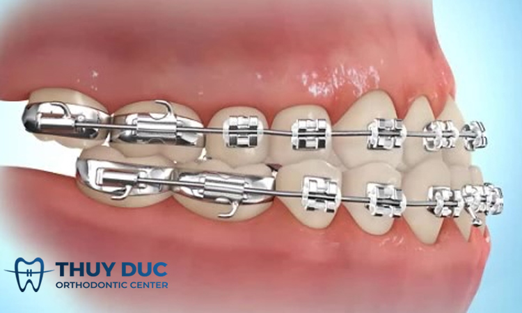 Điều trị móm răng ở người trưởng thành 1