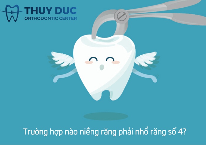 Tại sao niềng răng phải nhổ răng số 4 mà không phải răng khác? 1 Tại sao niềng răng phải nhổ răng số 4 mà không phải răng khác? 1