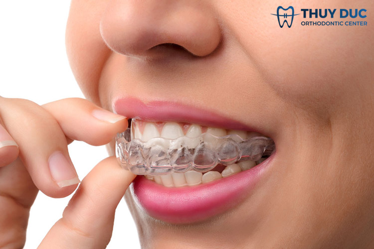 5. Niềng răng trong suốt Invisalign 1 5. Niềng răng trong suốt Invisalign 1