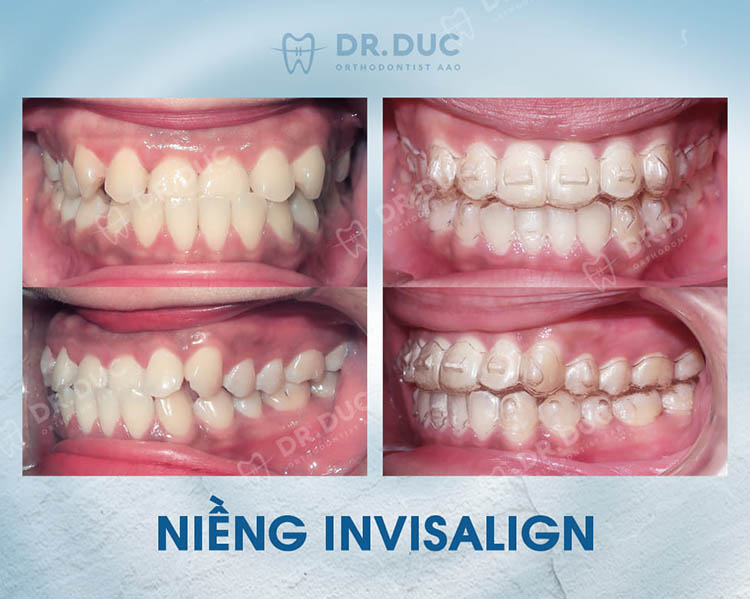Niềng răng trong suốt Invisalign 3