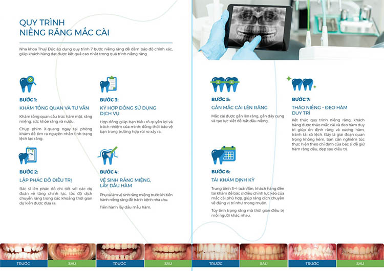 Quy trình niềng răng tại nha khoa Thuý Đức 1
