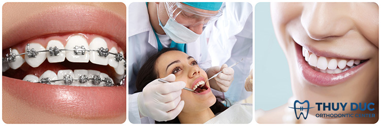 Răng hô có chữa được không? 1 Răng hô có chữa được không? 1