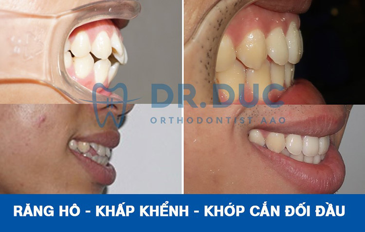 Hình ảnh trước – sau niềng răng với răng sai khớp cắn 4 Hình ảnh trước – sau niềng răng với răng sai khớp cắn 4