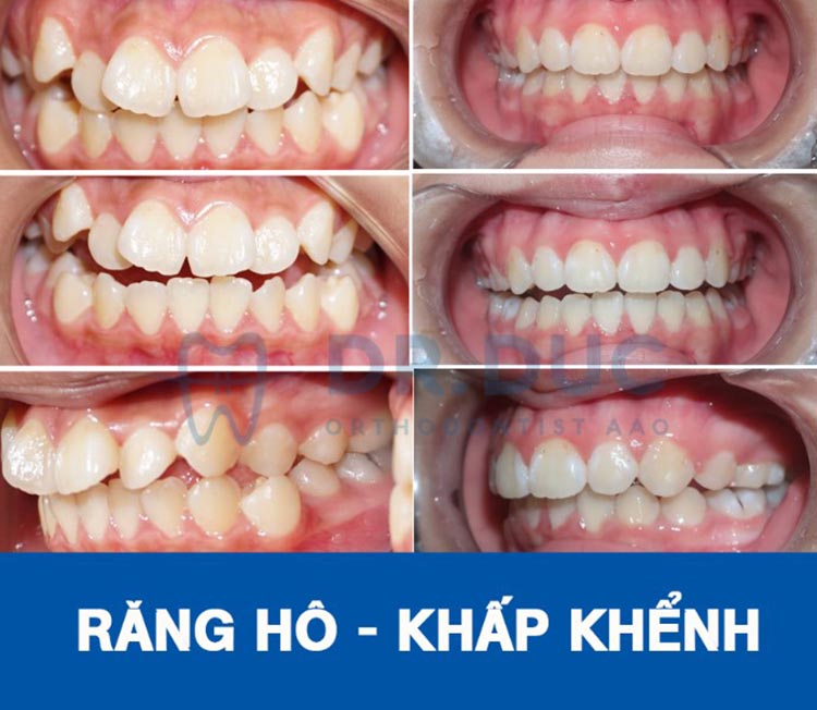 Hình ảnh trước – sau niềng răng với răng phức tạp khác 2 Hình ảnh trước – sau niềng răng với răng phức tạp khác 2