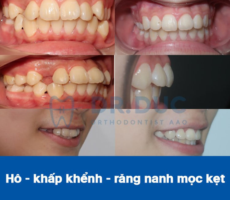 Hình ảnh trước – sau niềng răng với răng phức tạp khác 3 Hình ảnh trước – sau niềng răng với răng phức tạp khác 3