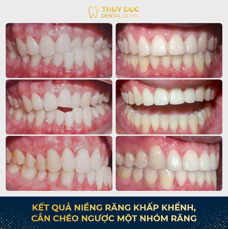 Hình ảnh trước – sau niềng răng với răng sai khớp cắn 5 Hình ảnh trước – sau niềng răng với răng sai khớp cắn 5