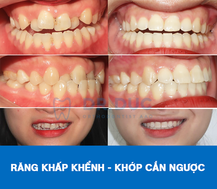 Hình ảnh trước – sau niềng răng với răng sai khớp cắn 6 Hình ảnh trước – sau niềng răng với răng sai khớp cắn 6