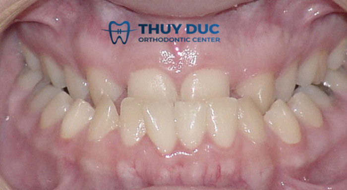 Đặc điểm để nhận dạng khớp cắn ngược? 1