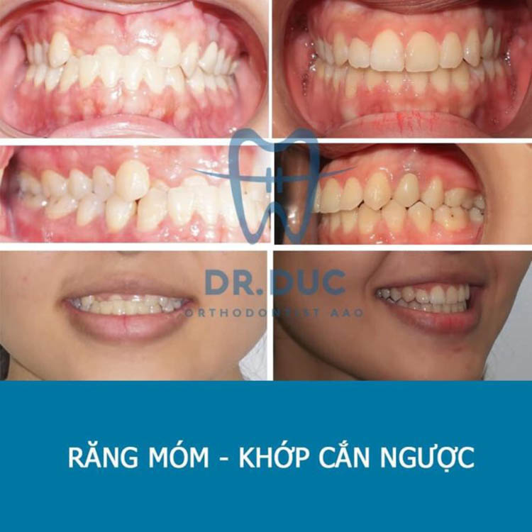 Móm Duyên là như thế nào Có cần điều trị không