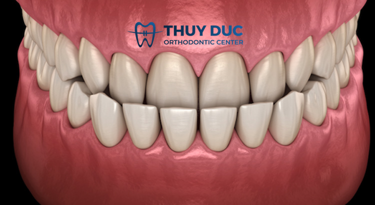 Răng móm là gì? 1 Răng móm là gì? 1